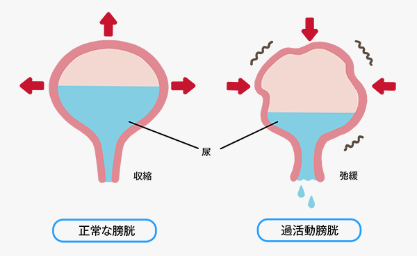 過活動膀胱