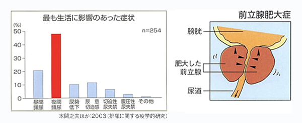 経尿道的前立腺レーザー蒸散術